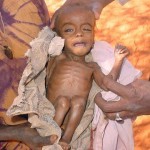 20054142_malnourished_child_somalia 20054142_malnourished_child_somalia